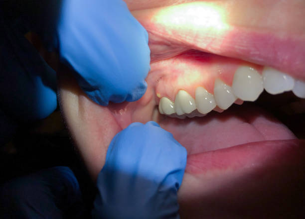 Best Broken or Chipped Tooth Repair in Laurel Lake, NJ